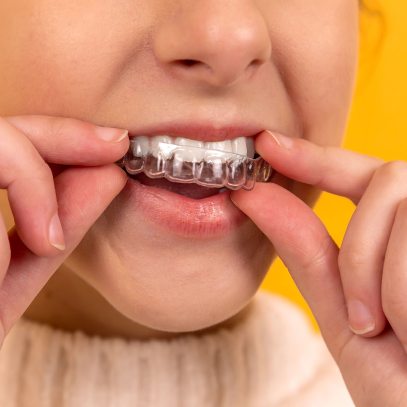 Smile Makeover