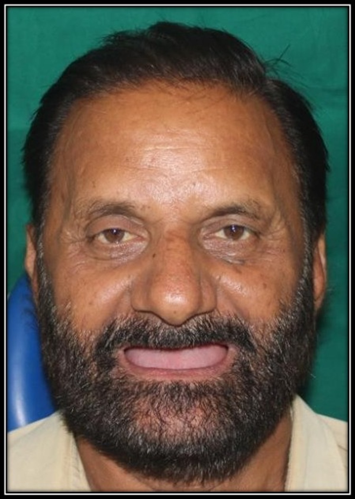 Dental treatment before result 3