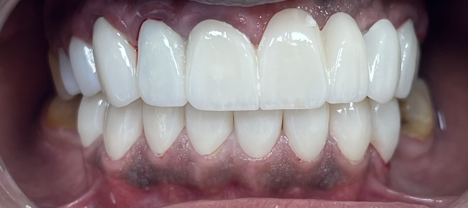 Patient smile result