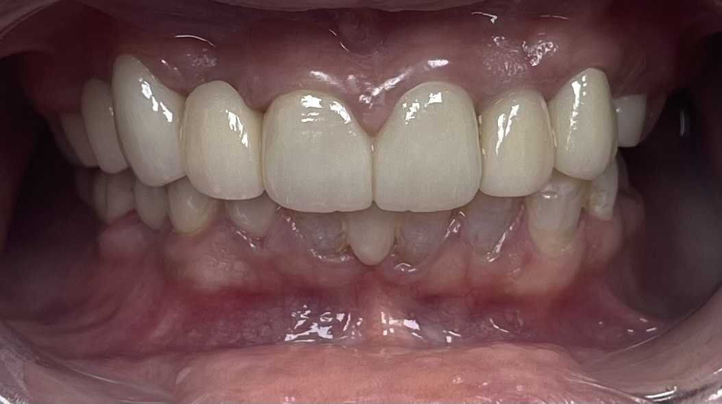 Patient smile result